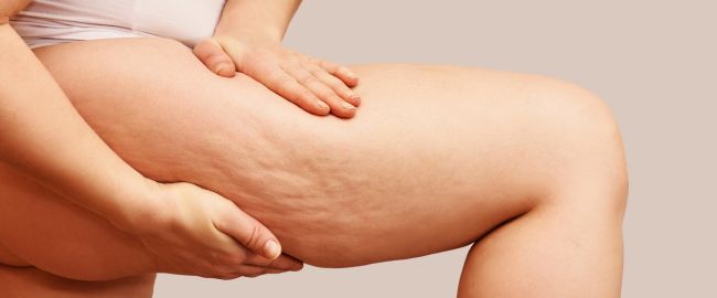 Cellulite: Sveliamo i Segreti e Abbracciamo la Bellezza!