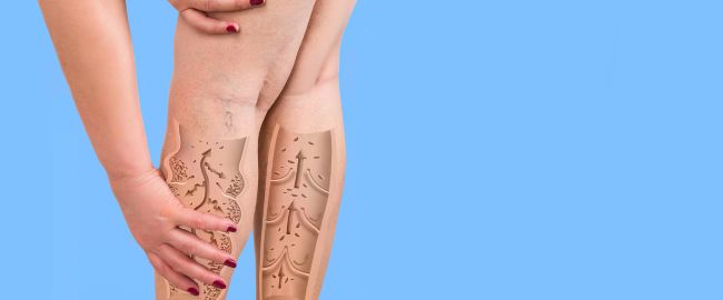 Gonfiore delle gambe